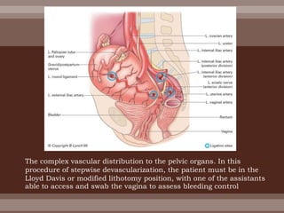 The complex vascular distribution to the pelvic organs. In this
procedure of stepwise devascularization, the patient must be in the
Lloyd Davis or modified lithotomy position, with one of the assistants
able to access and swab the vagina to assess bleeding control
 