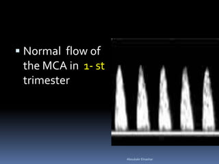 Mca Graph Normal Management of Rh-Sensitized Pregnant Patient | PDF