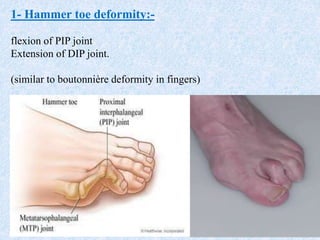 1- Hammer toe deformity:-
flexion of PIP joint
Extension of DIP joint.
(similar to boutonnière deformity in fingers)
 