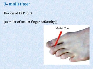 3- mallet toe:
flexion of DIP joint
((((similar of mallet finger deformity
 