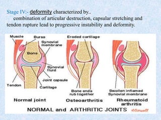 Stage IV:- deformity characterized by..
combination of articular destruction, capsular stretching and
tendon rupture lead to progressive instability and deformity.
 