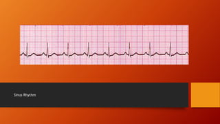 Rhythm recognition | PPTX