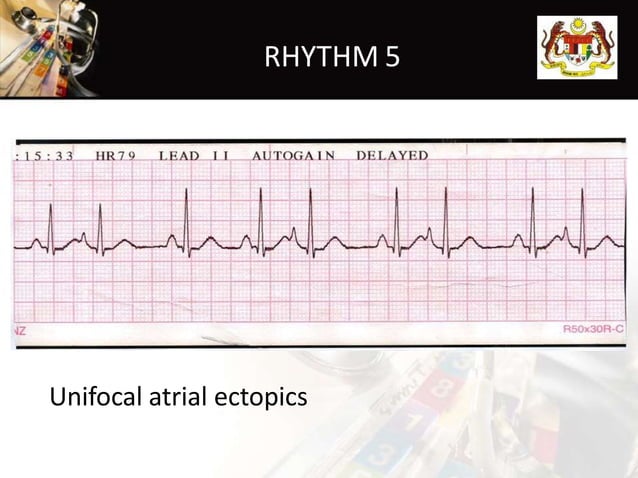 Rhythm recognition | PPT