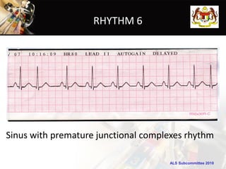 RHYTHM 6




Sinus with premature junctional complexes rhythm

                                     ALS Subcommittee 2010
 
