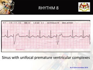 RHYTHM 8




Sinus with unifocal premature ventricular complexes

                                       ALS Subcommittee 2010
 
