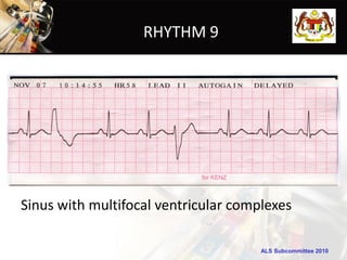 RHYTHM 9




Sinus with multifocal ventricular complexes

                                      ALS Subcommittee 2010
 