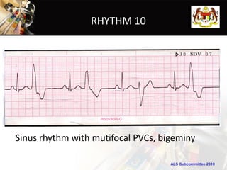 RHYTHM 10




Sinus rhythm with mutifocal PVCs, bigeminy

                                    ALS Subcommittee 2010
 