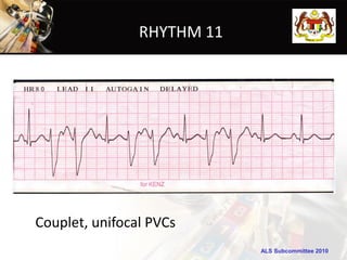 RHYTHM 11




Couplet, unifocal PVCs
                            ALS Subcommittee 2010
 