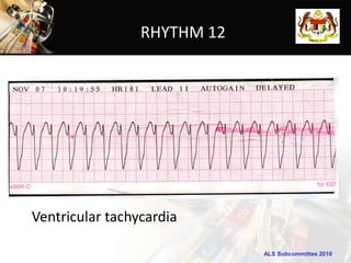 RHYTHM 12




Ventricular tachycardia

                             ALS Subcommittee 2010
 