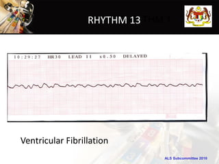RHYTHM 13
                       RHYTHM 1




Ventricular Fibrillation
                             ALS Subcommittee 2010
 