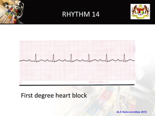 RHYTHM 14




First degree heart block

                           ALS Subcommittee 2010
 