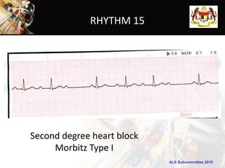 RHYTHM 15




Second degree heart block
     Morbitz Type I
                            ALS Subcommittee 2010
 