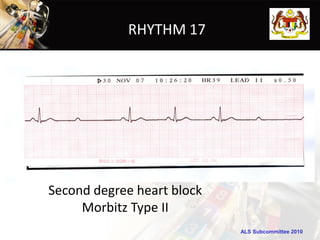 RHYTHM 17




Second degree heart block
     Morbitz Type II
                            ALS Subcommittee 2010
 