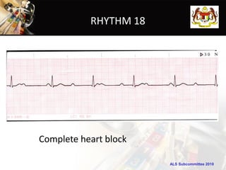 RHYTHM 18




Complete heart block

                       ALS Subcommittee 2010
 