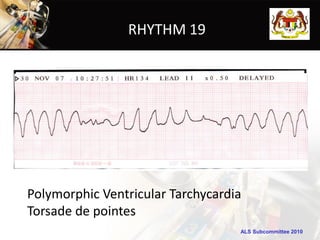 RHYTHM 19




Polymorphic Ventricular Tarchycardia
Torsade de pointes
                                   ALS Subcommittee 2010
 
