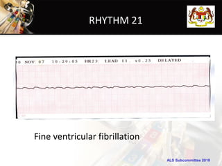 RHYTHM 21




Fine ventricular fibrillation

                                ALS Subcommittee 2010
 
