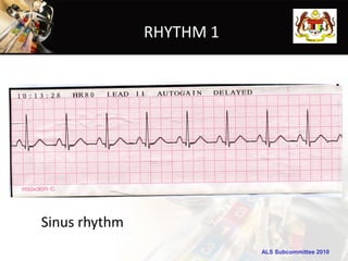 RHYTHM 1




Sinus rhythm
                          ALS Subcommittee 2010
 