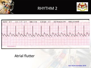 RHYTHM 2




Atrial flutter

                            ALS Subcommittee 2010
 