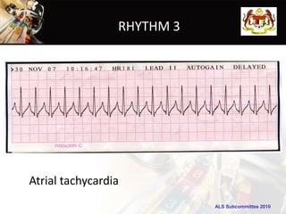 RHYTHM 3




Atrial tachycardia
                            ALS Subcommittee 2010
 
