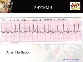 RHYTHM 4




Atrial fibrillation
                                 ALS Subcommittee 2010
 