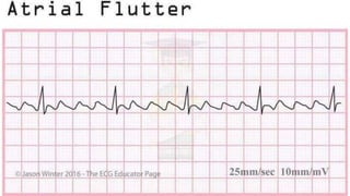 basic ECG rhythms & rhythms on different conditions