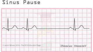 basic ECG rhythms & rhythms on different conditions