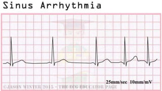 basic ECG rhythms & rhythms on different conditions
