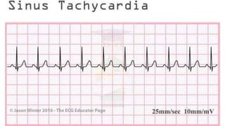 basic ECG rhythms & rhythms on different conditions