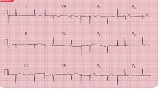 basic ECG rhythms & rhythms on different conditions