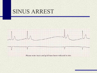 SINUS ARREST 