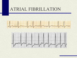 ATRIAL FIBRILLATION 