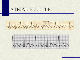 ATRIAL FLUTTER 
