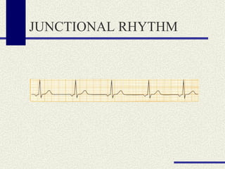 JUNCTIONAL RHYTHM  