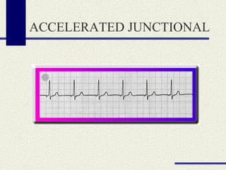 ACCELERATED JUNCTIONAL 