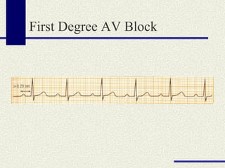 First Degree AV Block 