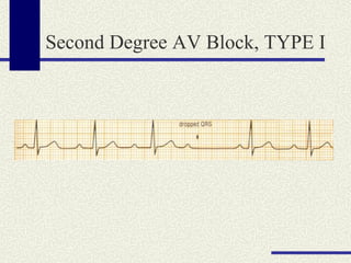 Second Degree AV Block, TYPE I 