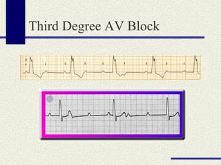 Third Degree AV Block 