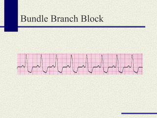 Bundle Branch Block 
