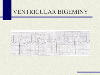 VENTRICULAR BIGEMINY 