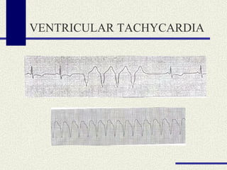 VENTRICULAR TACHYCARDIA 