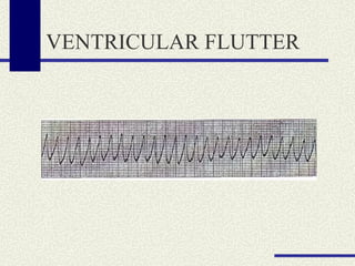 VENTRICULAR FLUTTER 