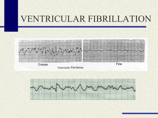 VENTRICULAR FIBRILLATION 
