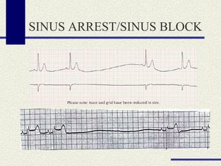 SINUS ARREST/SINUS BLOCK 