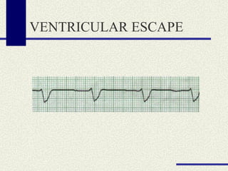 VENTRICULAR ESCAPE 