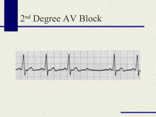 2 nd  Degree AV Block 