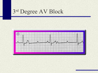 3 rd  Degree AV Block 