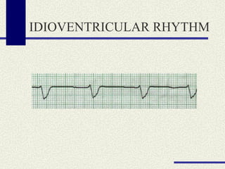 IDIOVENTRICULAR RHYTHM 
