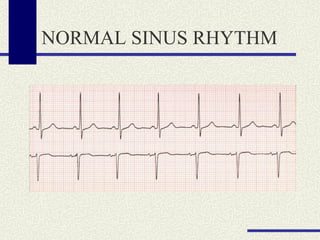 NORMAL SINUS RHYTHM 