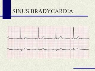 SINUS BRADYCARDIA 