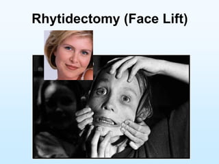 Rhytidectomy (Face Lift)
 